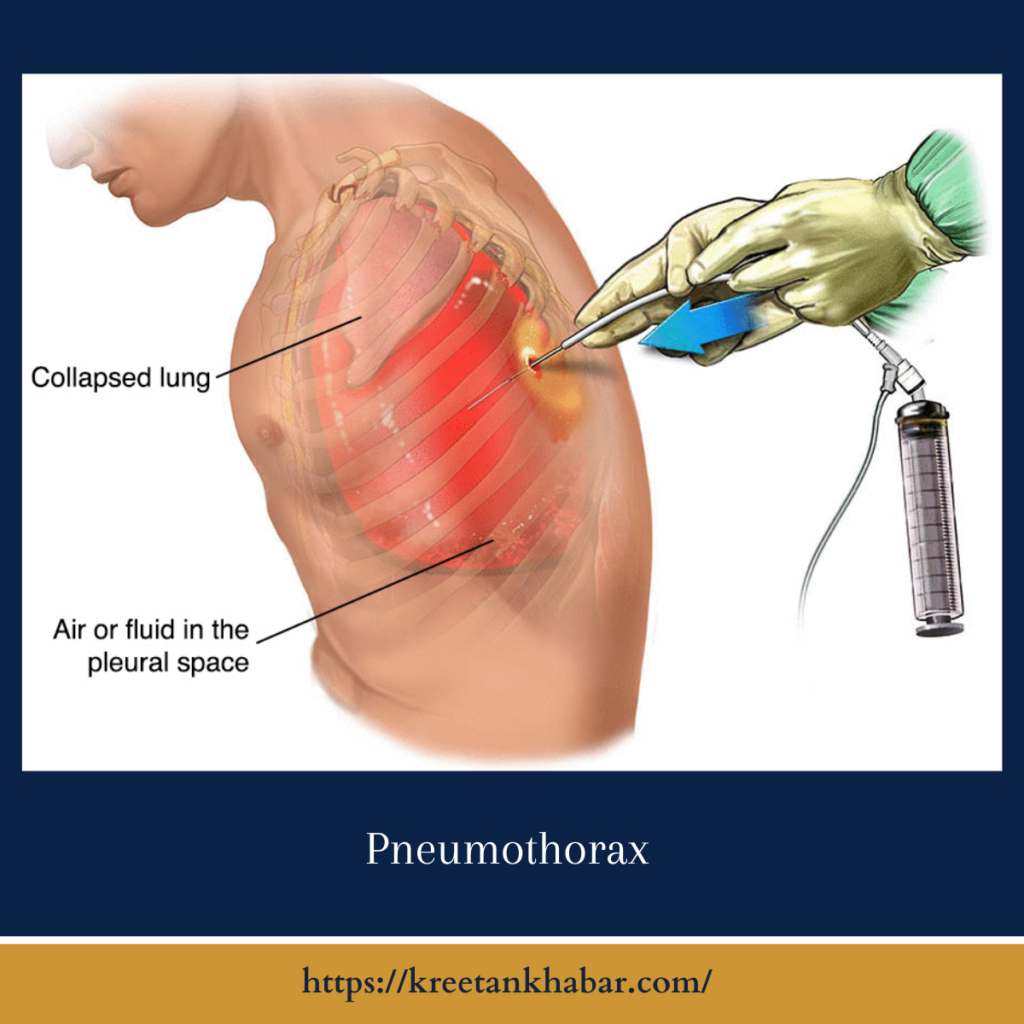 Pneumothorax