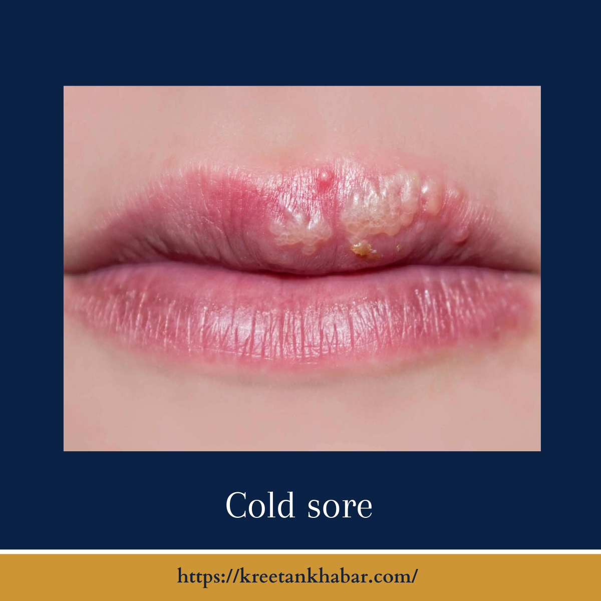 Understanding Cold Sores: Causes, Symptoms, and Treatment - Kreetan ...