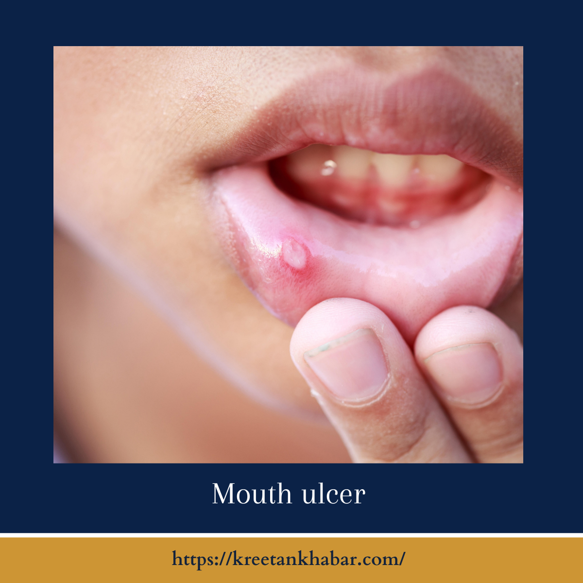 understanding-mouth-ulcers-causes-symptoms-and-treatment-kreetan