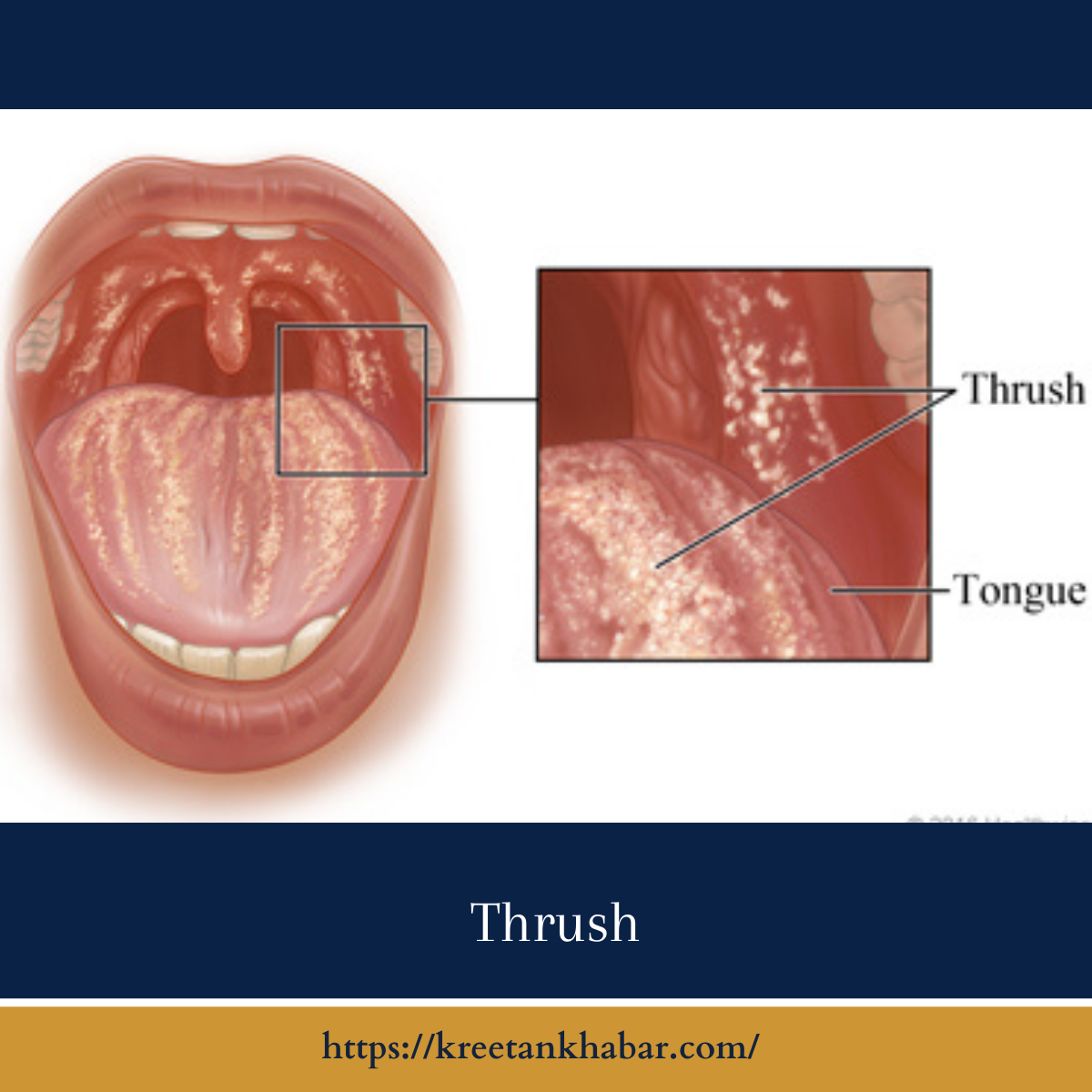 Understanding Thrush: Causes, Symptoms, and Treatment - Kreetan Khabar 2023