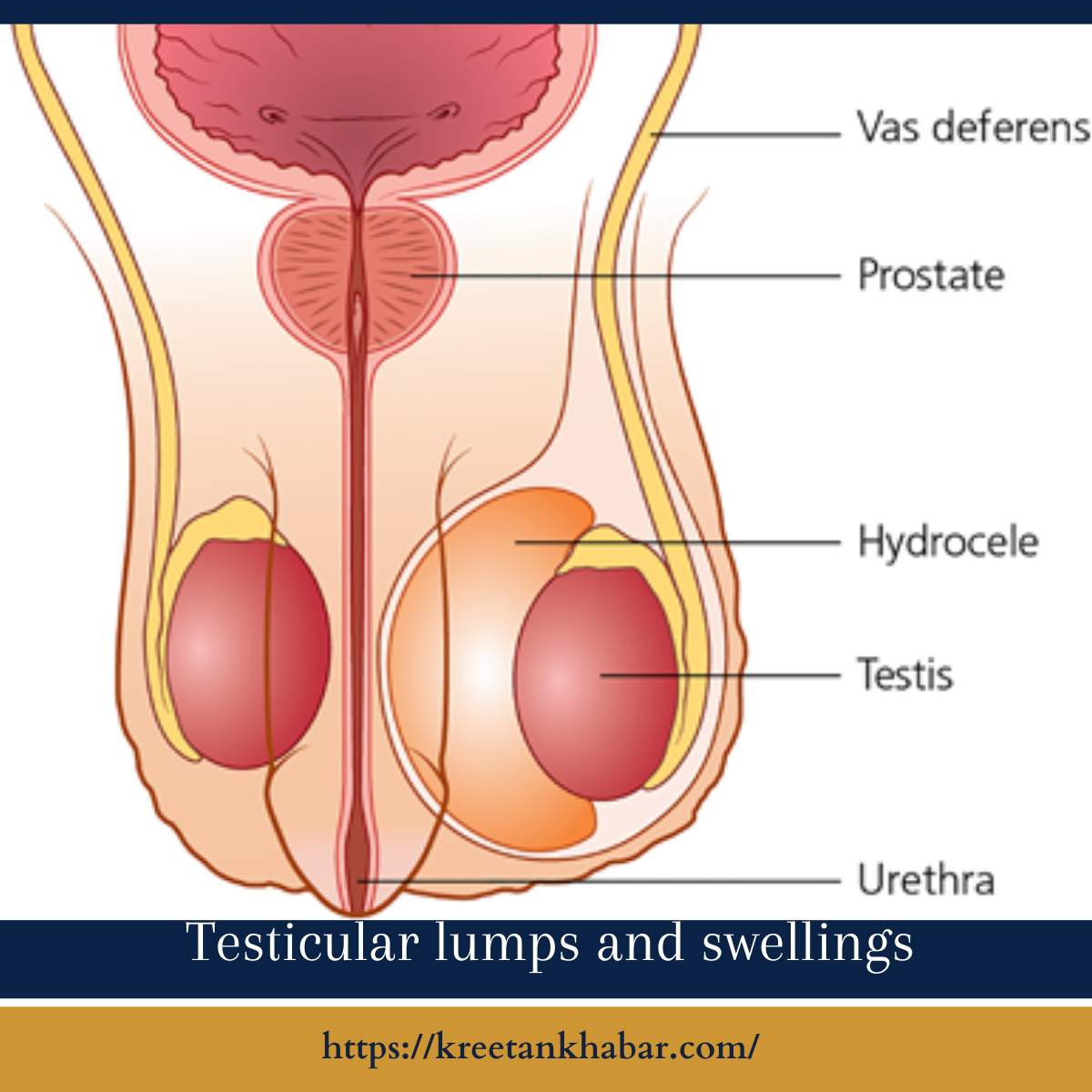 Testicular Lumps And Swellings Causes Evaluation And Treatment Kreetan Khabar 2023