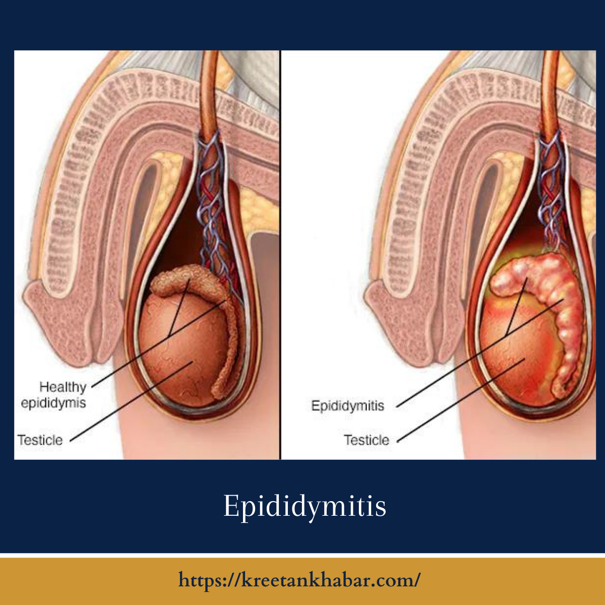 Epididymitis Understanding Causes Symptoms Diagnosis And Treatment Kreetan Khabar 