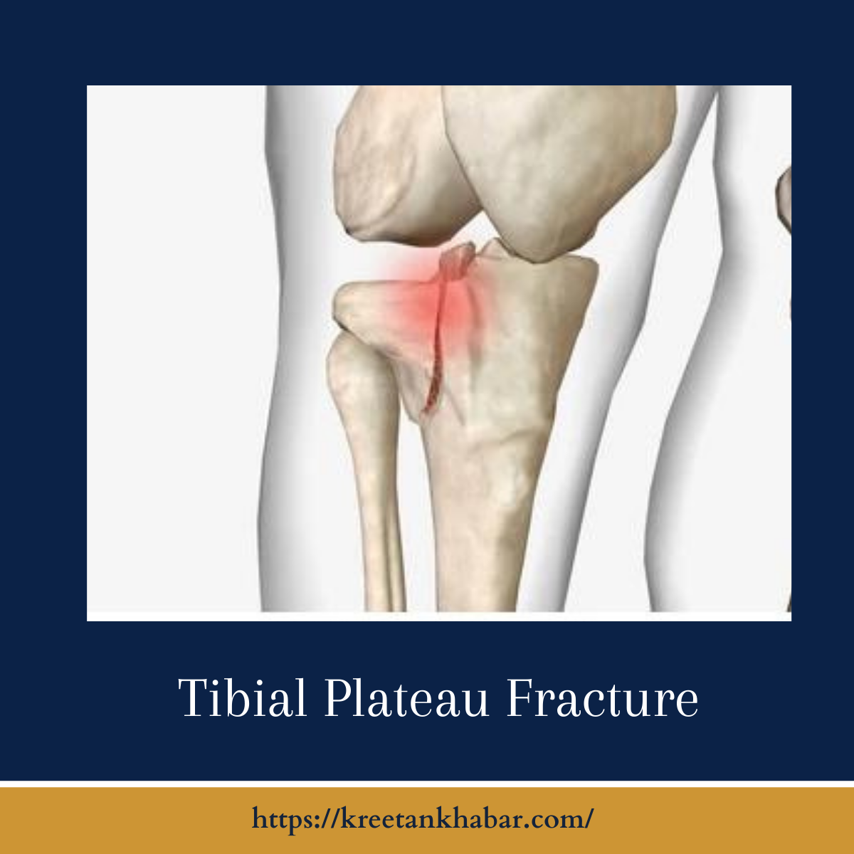 Does Tibial Plateau Fracture Require Surgery