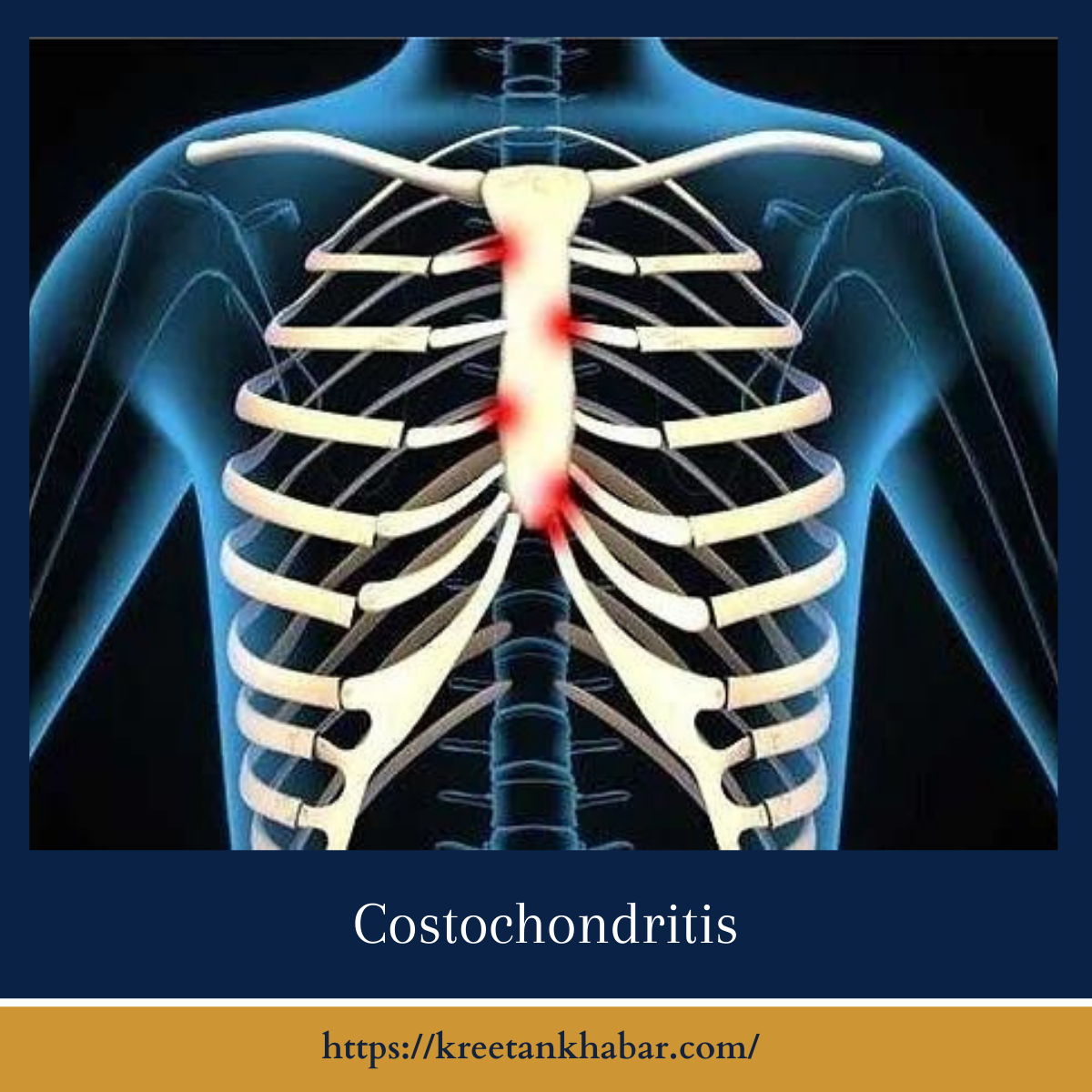 Costochondritis A Guide to Managing Chest Pain Kreetan Khabar 2024