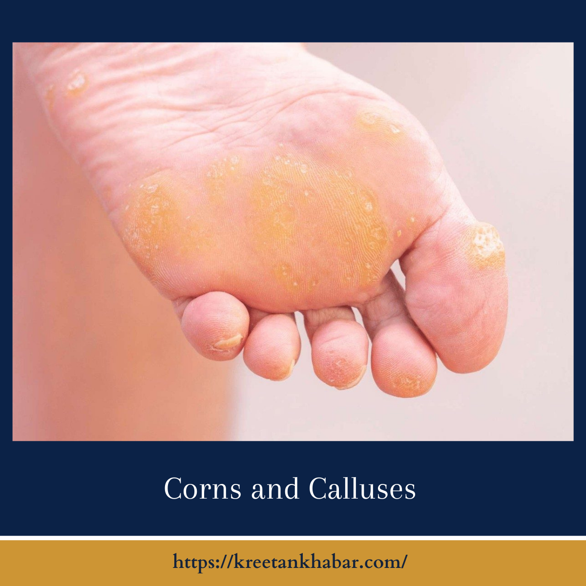 Corns and Calluses: Causes, Treatment, and Prevention - Kreetan Khabar 